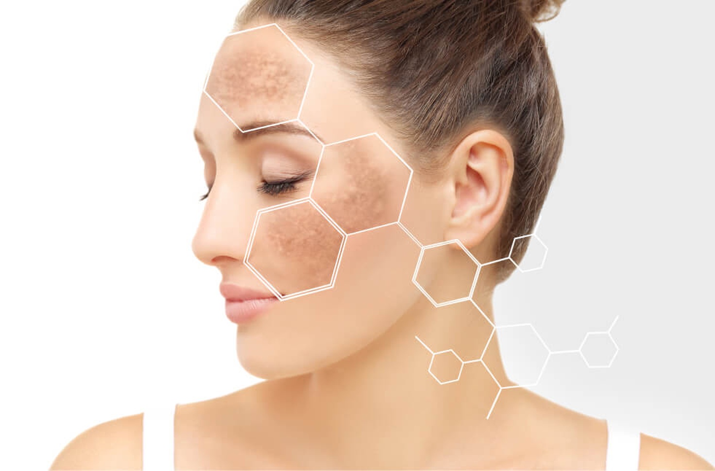 melasma_01.jpg